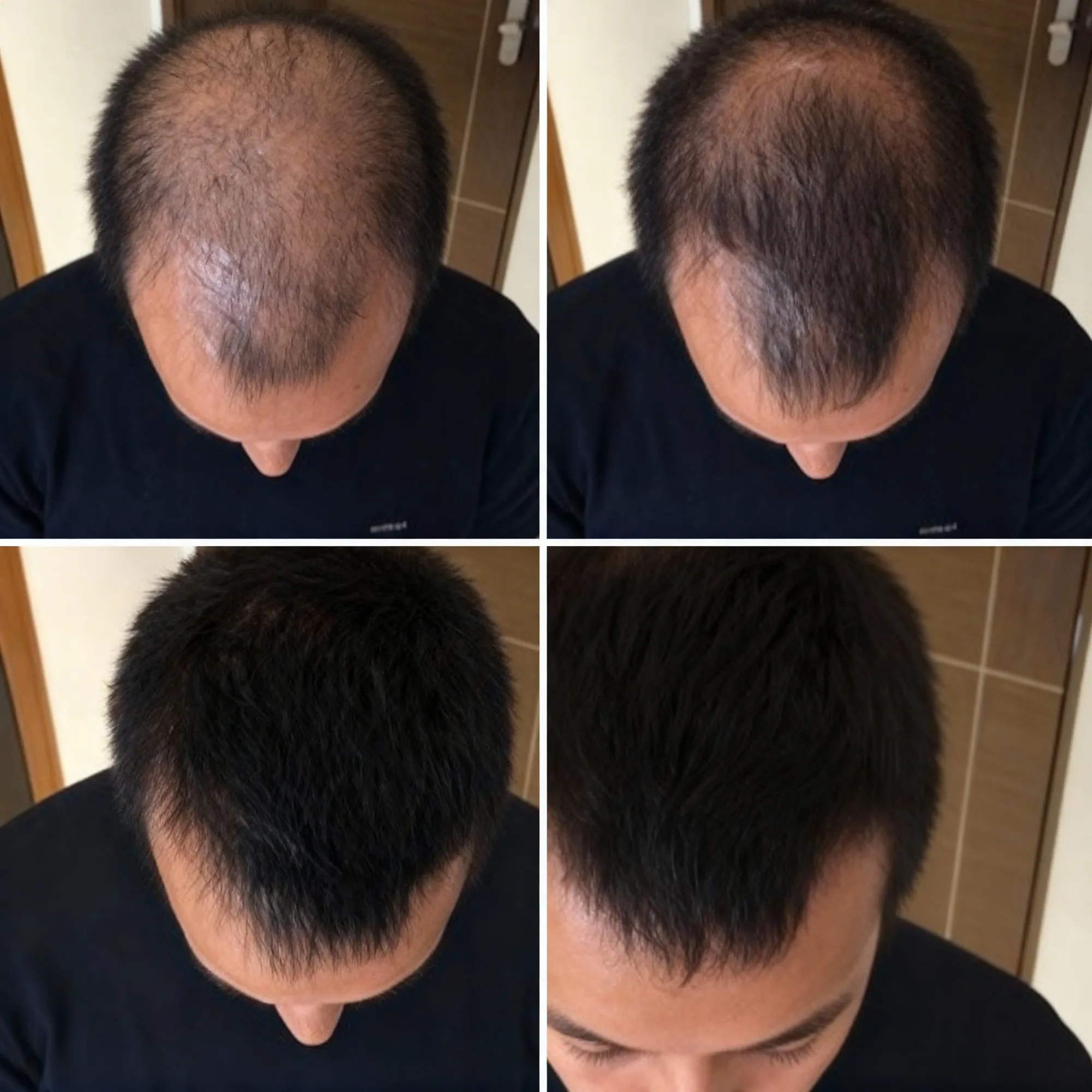 6 months progress. Hairline is BACK.